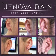 Ear Lobe Reconstruction by Jenova Rain in Leicester