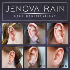 Ear Lobe Reconstruction by Jenova Rain UK