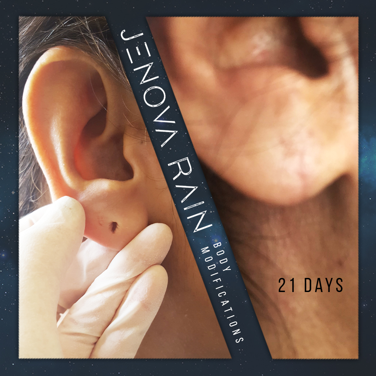 Ear Lobe Reconstruction UK
