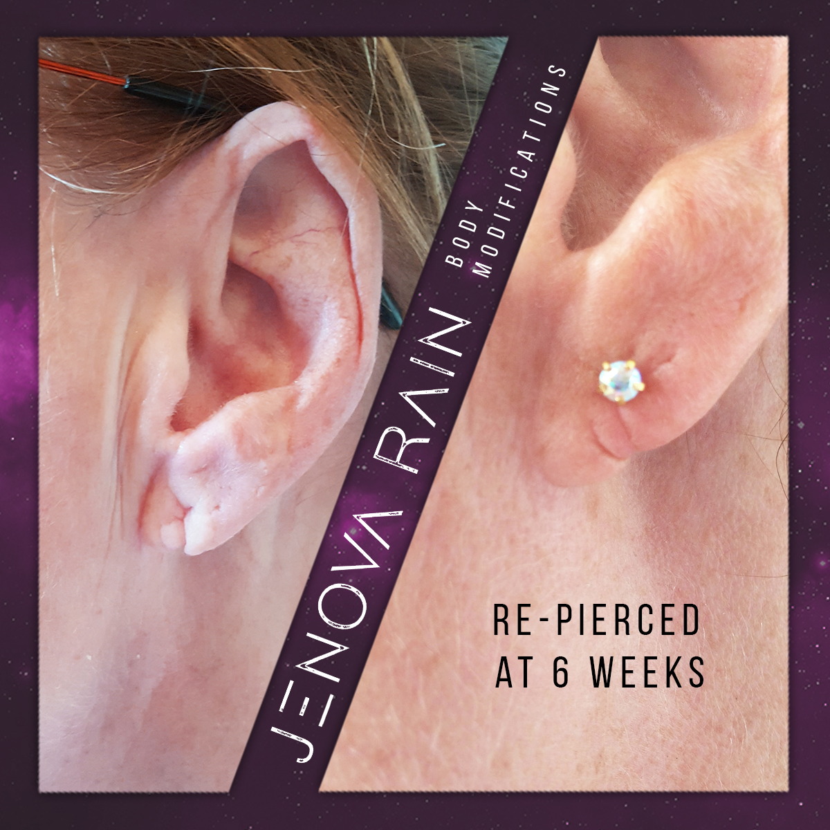 Ear Lobe Reconstruction UK by Jenova Rain