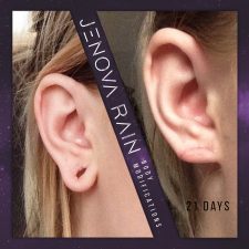 Stretched Ear Lobe Repair UK by Jenova Rain