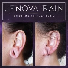 Before and after healed photos of surgery procedure to fix stretched ear lobes