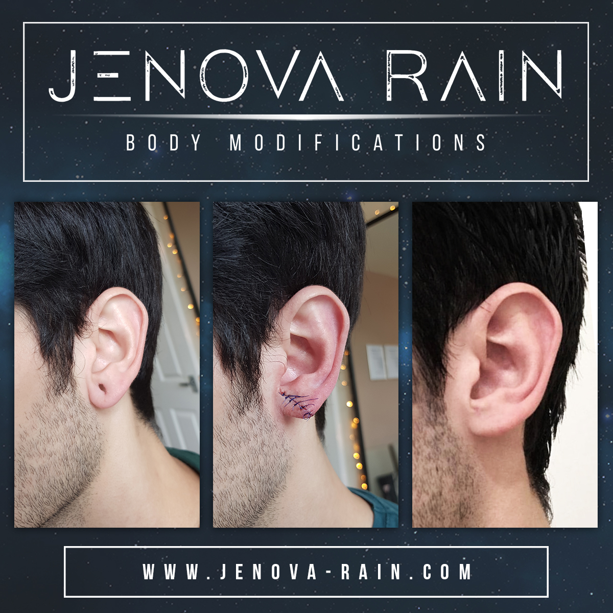 Before and after healed photos of surgery procedure to fix stretched ear lobes