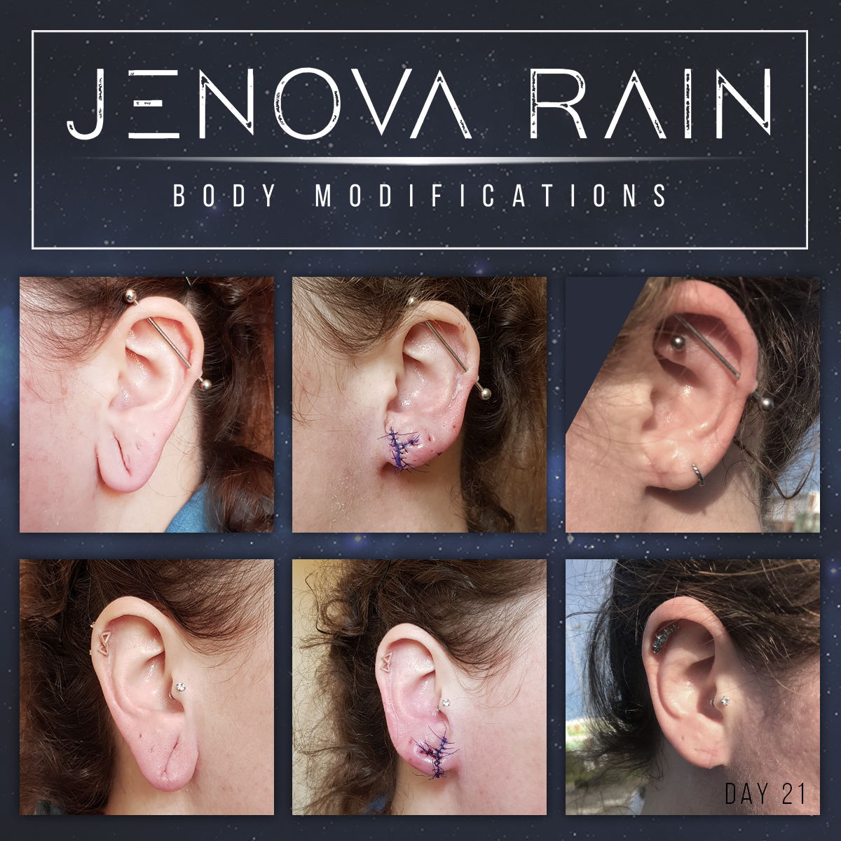 Ear Lobe Reconstruction UK Specialist Jenova Rain