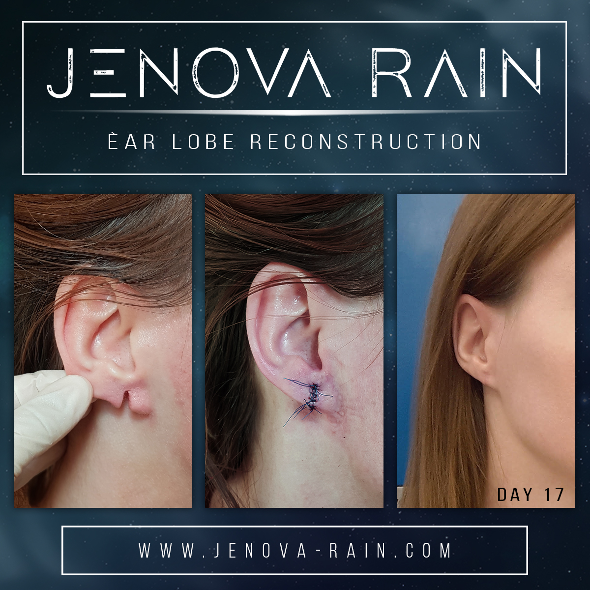 Ear lobe repair for stretched damaged ears before and after healed photos by jenova rain in leicester UK
