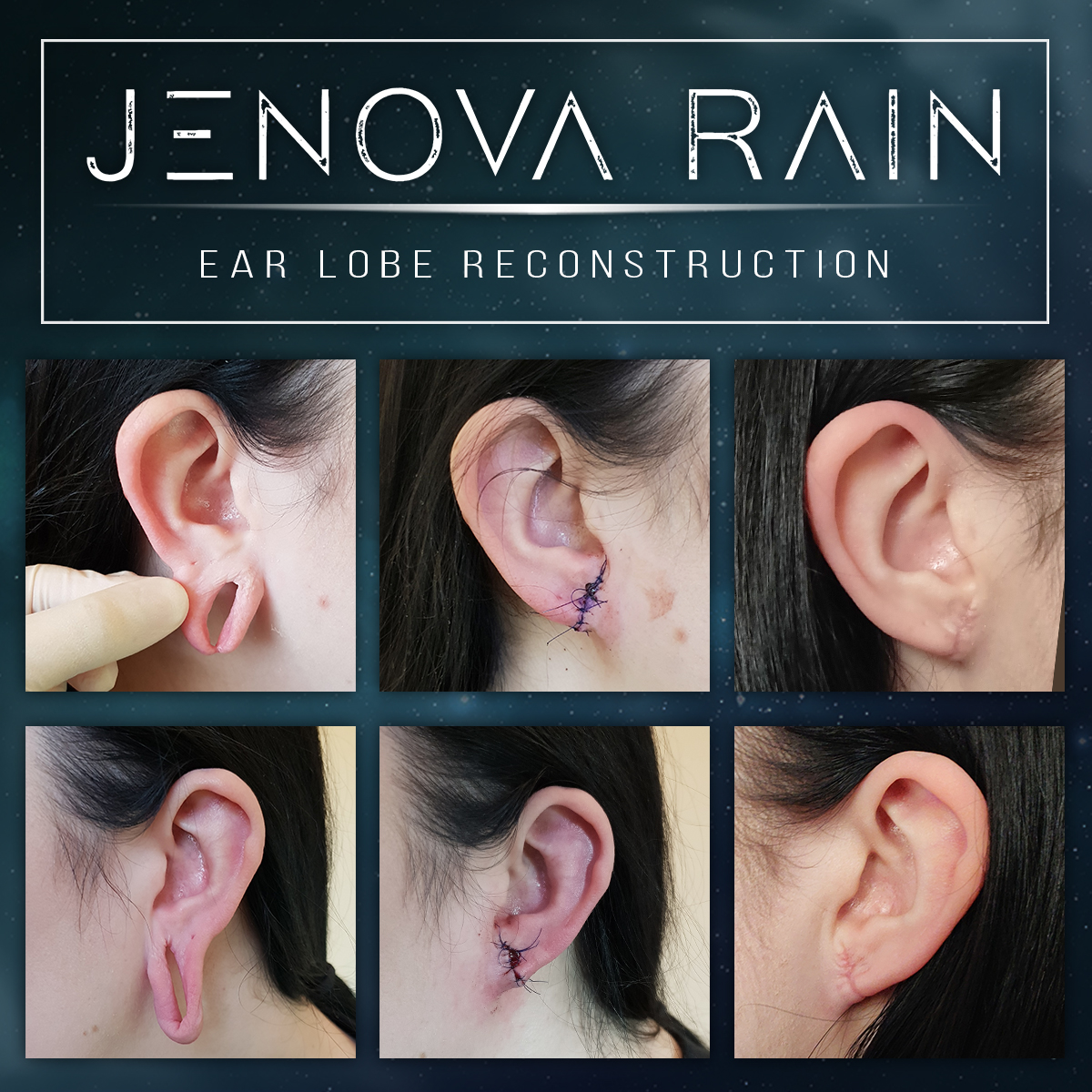 Ear lobe repair for stretched damaged ears before and after healed photos by jenova rain in leicester UK