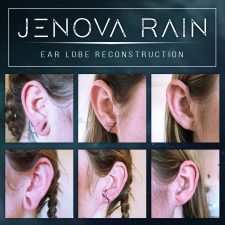 ear lobe reconstruction uk jenova rain