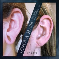 ear lobe reconstruction uk jenova rain