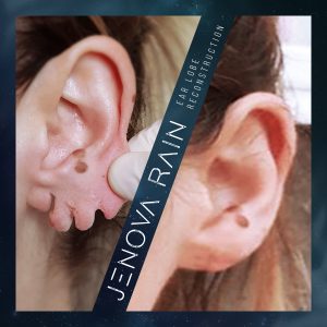stretched lobe repair
