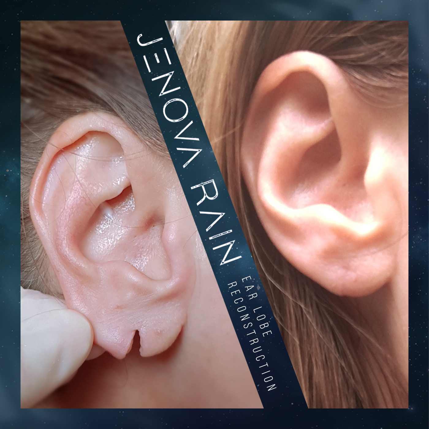 Jenova Rain » Stretched or Split Ear Lobe Reconstruction