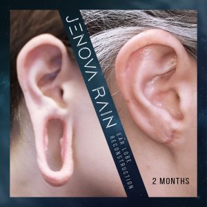 stretched lobe repair