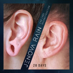 Stretched Ear Lobe Repair UK by Jenova Rain
