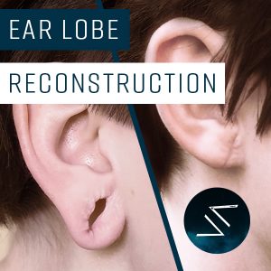 Stretched Ear Lobe Repair UK by Jenova Rain