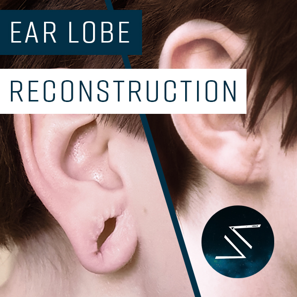 Ear Lobe Repair Surgery for stretched earring holes 